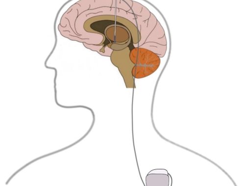 2-Minute Neuroscience: Deep Brain Stimulation