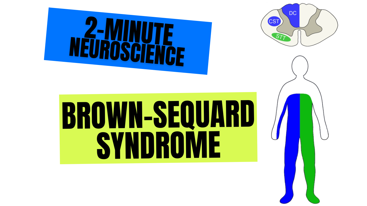 2-Minute Neuroscience: Brown-Séquard Syndrome