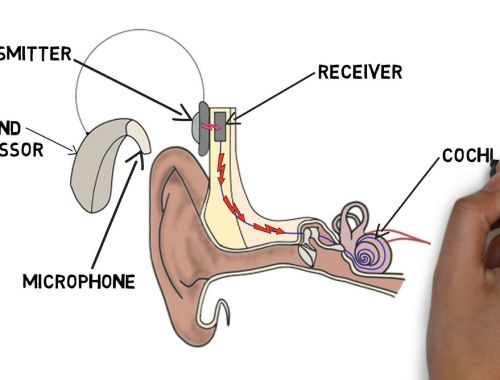 2-Minute Neuroscience: Cochlear Implants