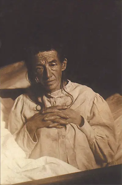 Auguste Deter, the subject of Alois Alzheimer’s case study describing what would come to be known as Alzheimer’s disease.