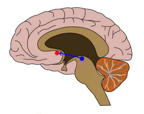 THE MESOLIMBIC DOPAMINE PATHWAY CONNECTING THE VENTRAL TEGMENTAL AREA (BLUE DOT) AND NUCLEUS ACCUMBENS (RED DOT).