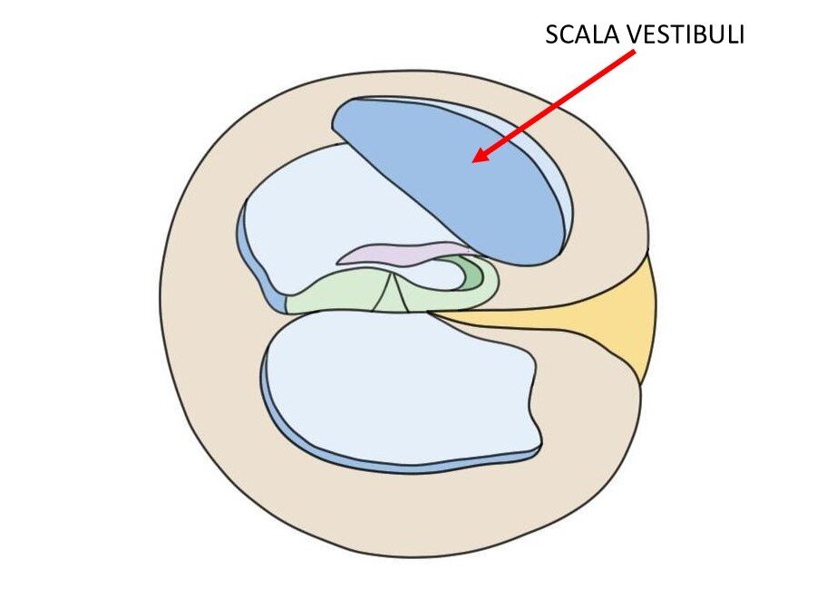 CROSS-SECTION OF THE COCHLEA WITH AN ARROW INDICATING THE SCALA VESTIBULI.