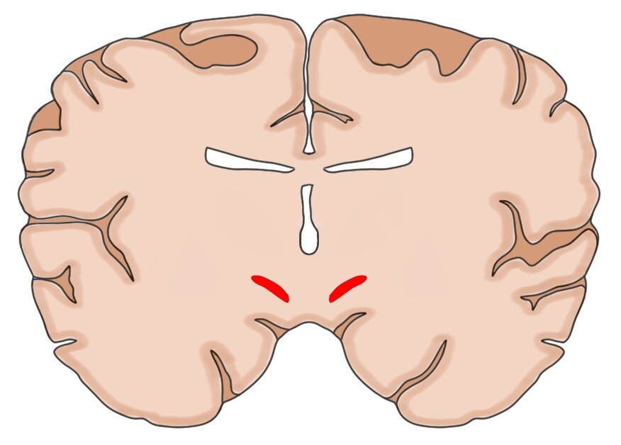 A CORONAL SECTION OF THE BRAIN SHOWING THE SUBTHALAMIC NUCLEI HIGHLIGHTED IN RED.