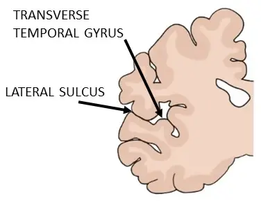 A CORONAL SECTION OF THE LEFT HEMISPHERE THAT SHOWS THE LOCATION OF ONE OF THE TRANSVERSE TEMPORAL GYRI.