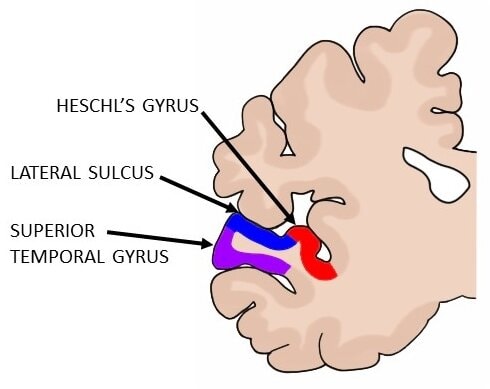 A coronal section of the left hemisphere, showing the primary auditory cortex (red) as well as surrounding auditory regions (blue and purple).
